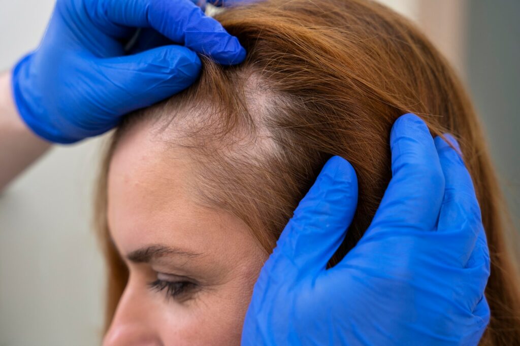 queda de cabelo: como cuidar e o que causa a queda capilar